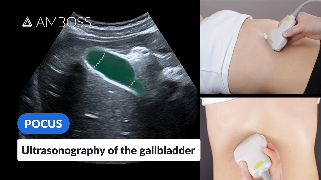 gallbladder ultrasound