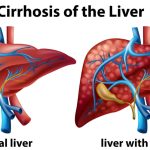 liver_cirrhosis