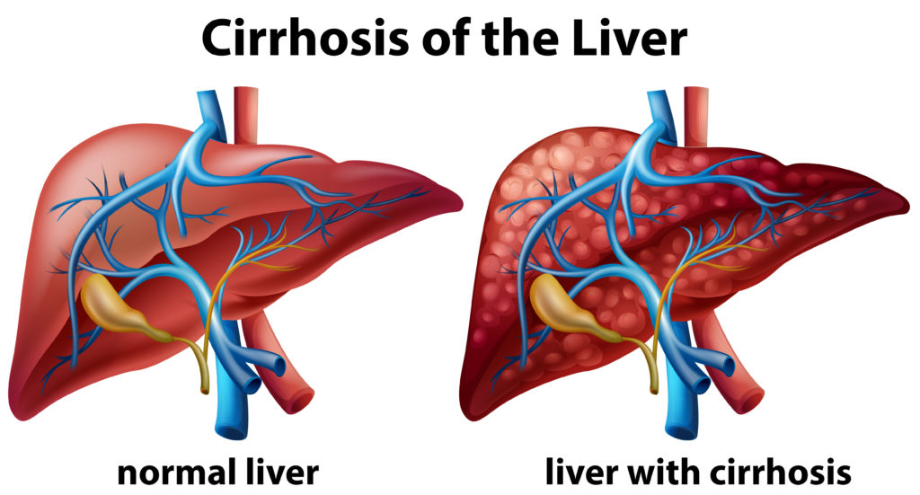 liver_cirrhosis