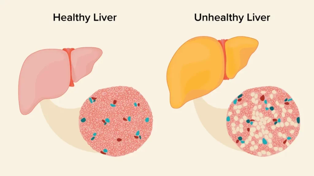 Discovering the Key Indicators of Liver Disease through Ultrasound