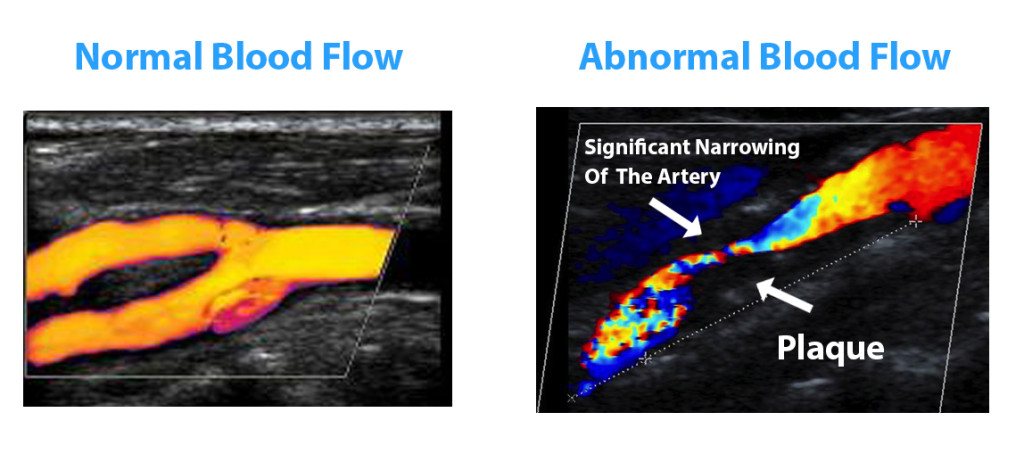 Carotid Doppler Detecting Arterial Disease - image shows blood flow