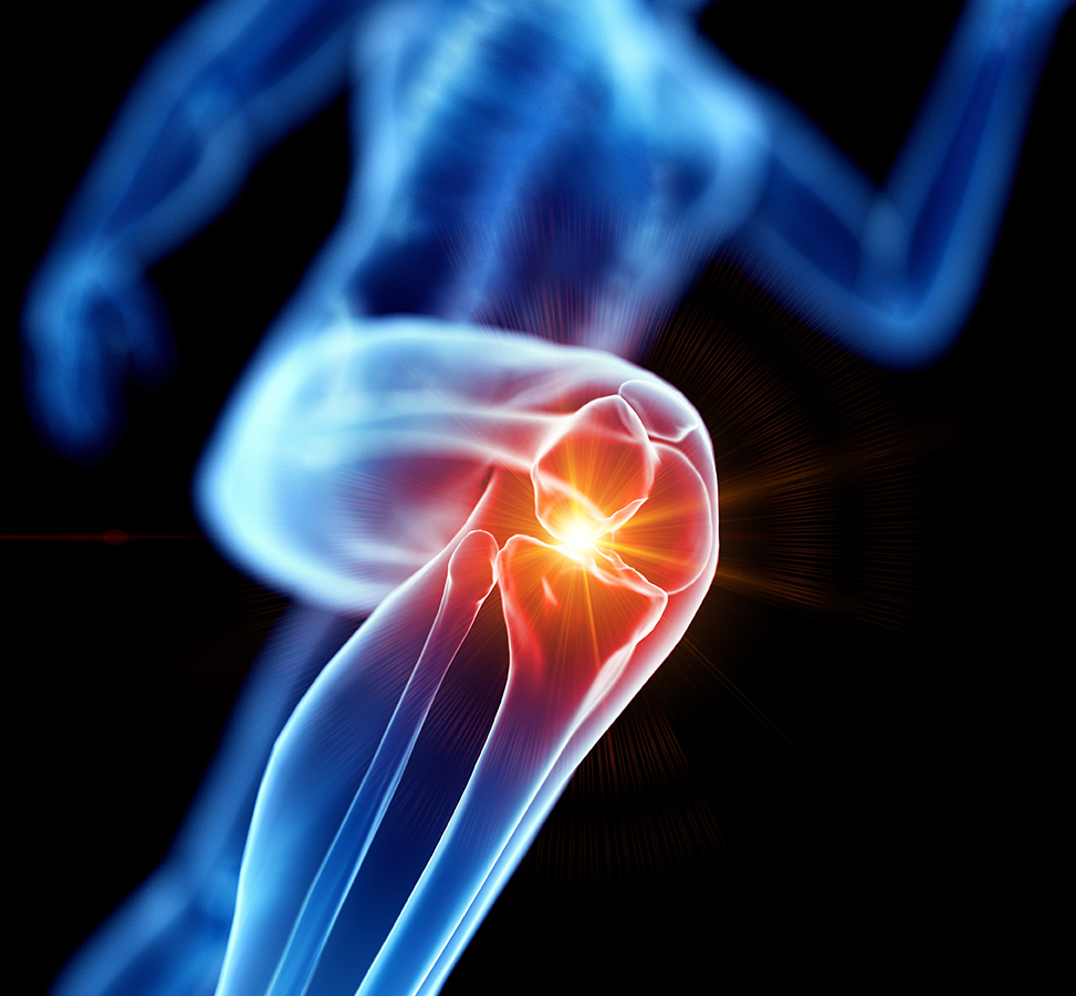 knee pain - image of the internal source of pain in the knee joint