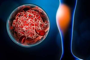 DVT Ultrasound Scan vs. Traditional Methods: Which is More Effective?
