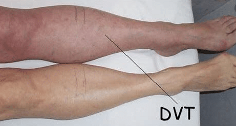Step-by-Step Guide: What to Expect During a DVT Ultrasound Scan