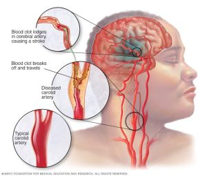 The Ultimate Guide to Preparing for a Carotid Doppler Ultrasound