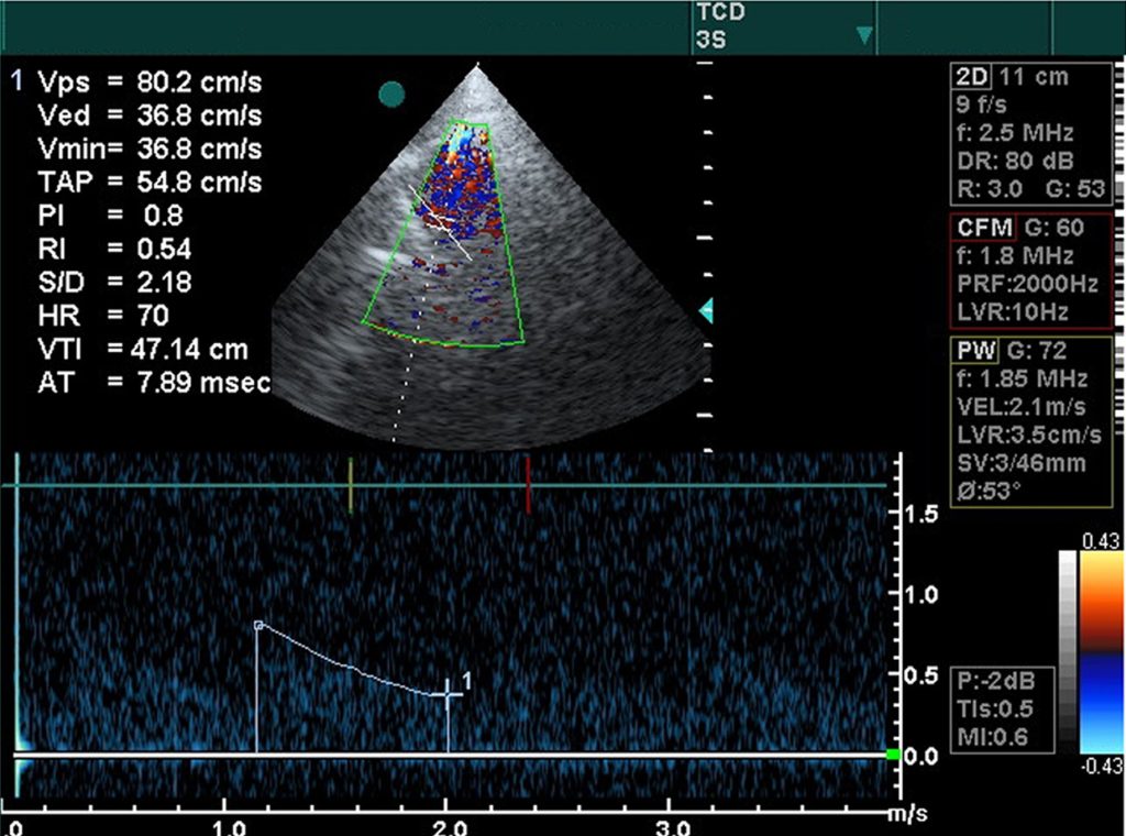 Ultrasound imaging for heart health - the echocardiagram