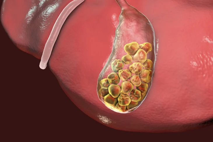 Gallbladder sludge: Symptoms, causes, and treatments