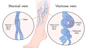 Varicose Vein Doppler Scan