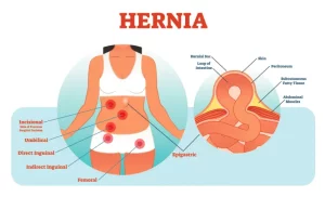 hernia ultrasound