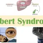 gilbert syndrome