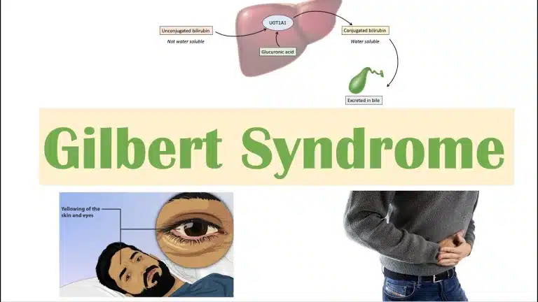 gilbert syndrome