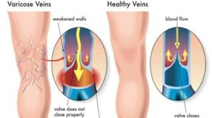 Doppler Test for Legs
