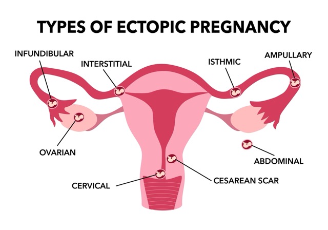 Private Ectopic Pregnancy Scan_London