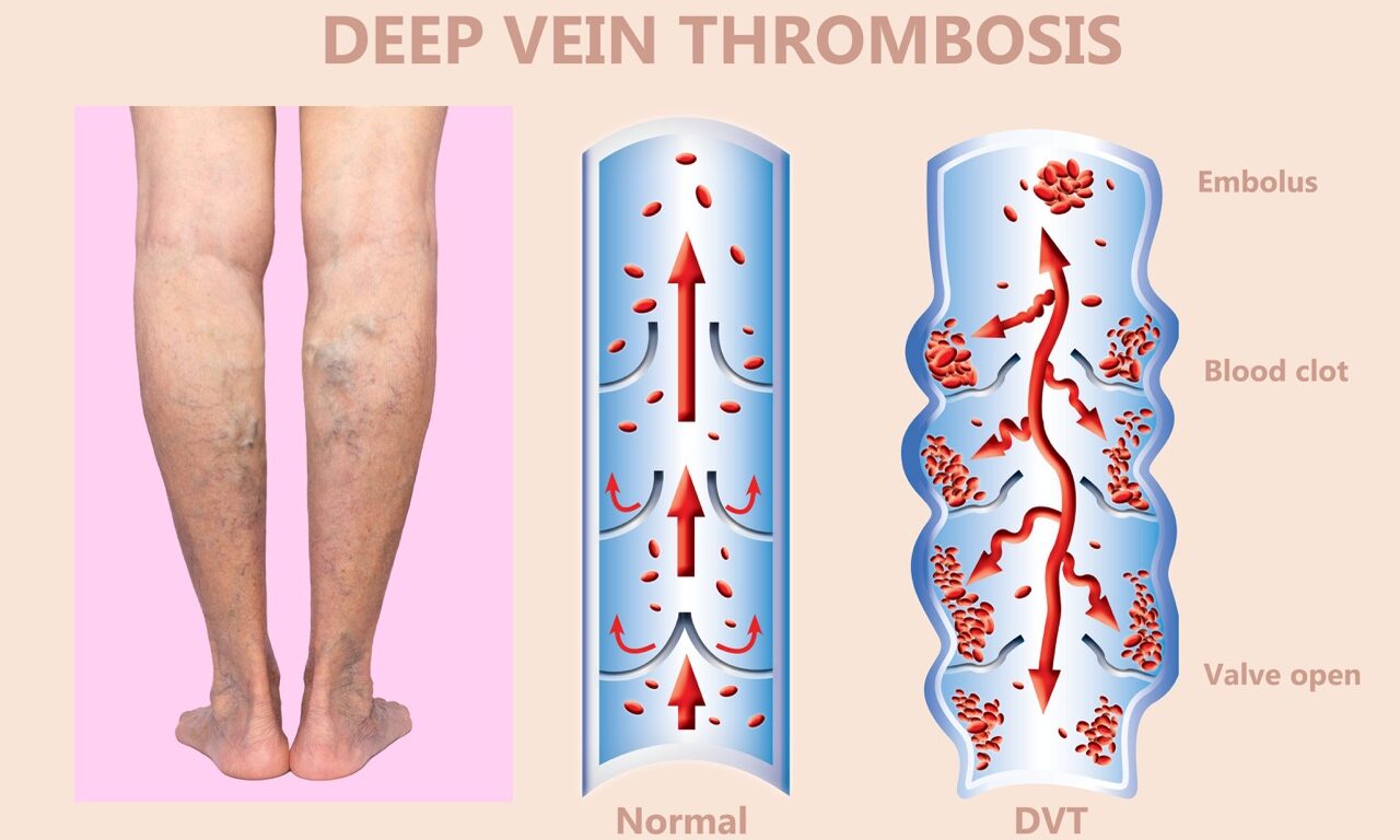 Deep Vein Thrombosis, DVT