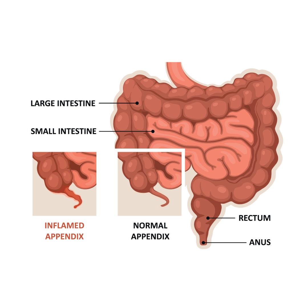 Appendicitis Health Check at London Private Ultrasound