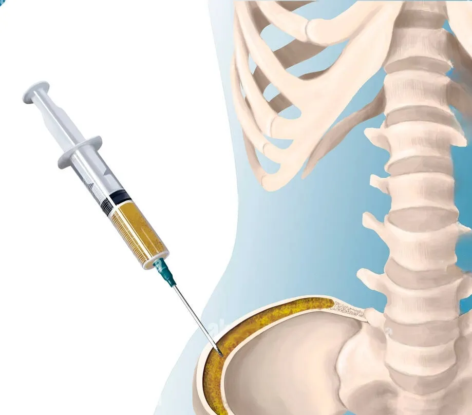 Bone Marrow Aspirate Concentrate (BMAC) Stem Cell Therapy | Private Ultrasound Scans and Health Checks | London Private Ultrasound