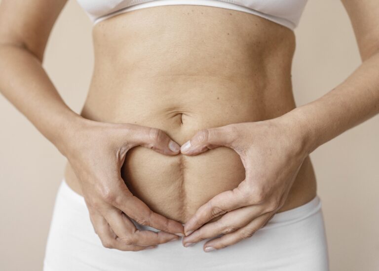 Diastasis Recti